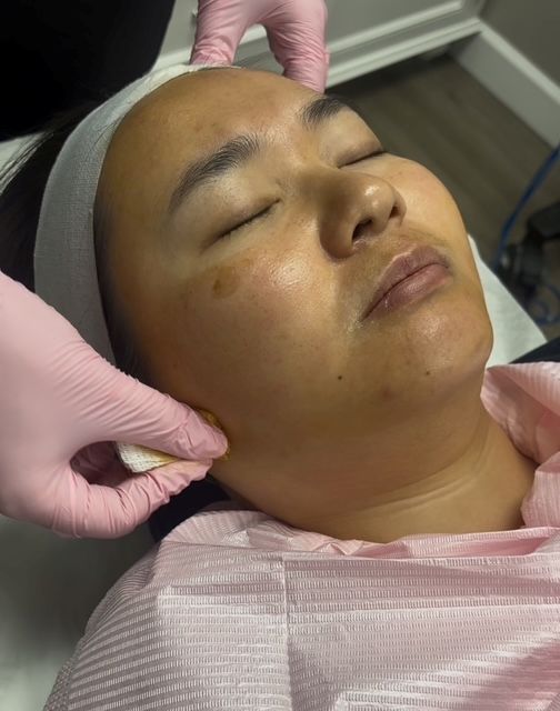 VI Peel