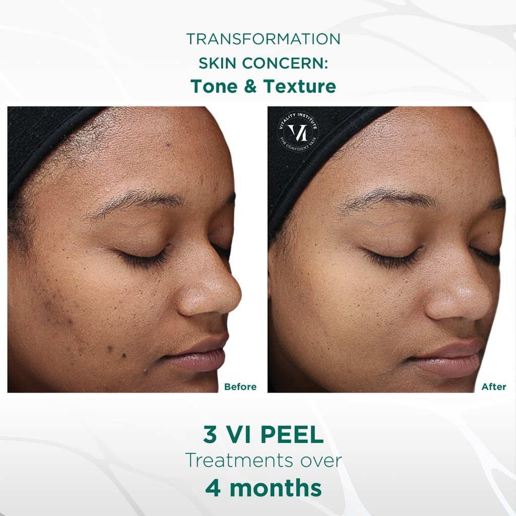 VI Peel