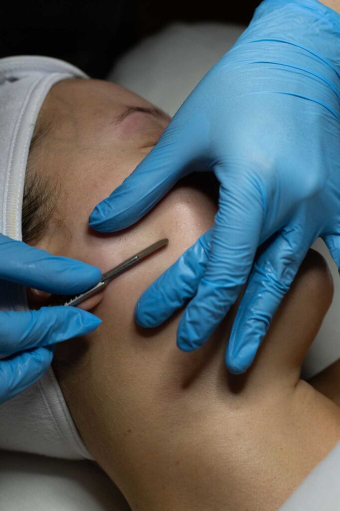 Dermaplaning